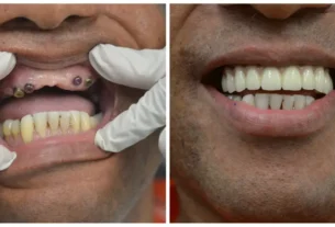 Mouth Reconstruction