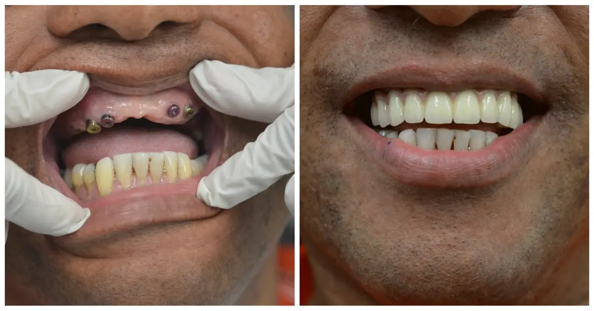 Mouth Reconstruction