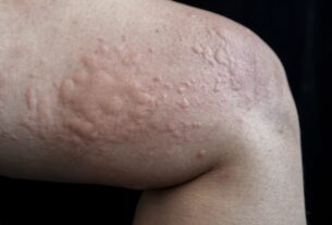 Chronic Hives